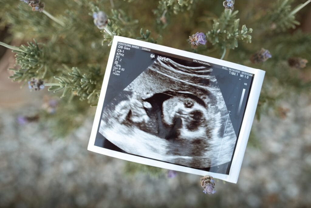 Dream About Twins on My Ultrasound